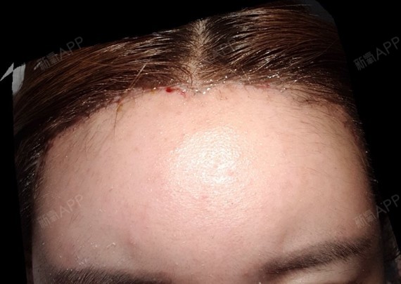 额头现在恢复的很好疤痕呢再恢复一段时间的话都会慢慢变淡的所以让我