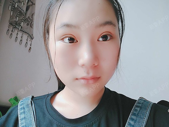 佳唯美切开双眼皮第10天美丽日记