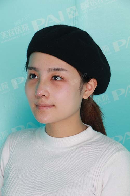 一世独立耳软骨复合隆鼻第10天美丽日记