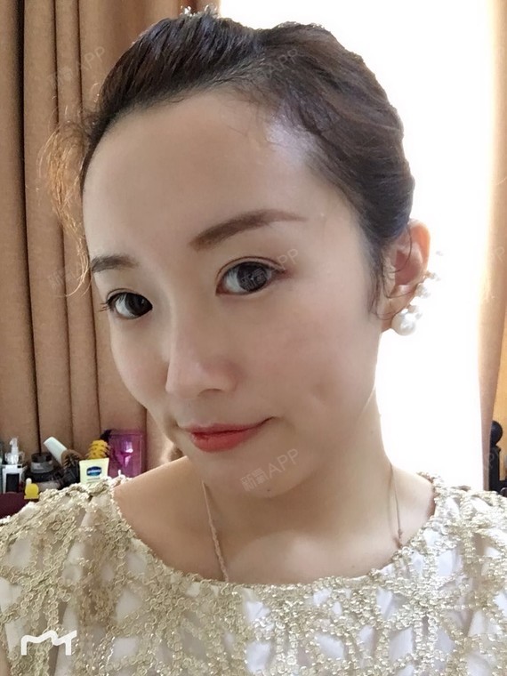 【埋线酒窝】一个月啦~好喜欢好喜欢,非常不后悔做这_圈子-新氧美容
