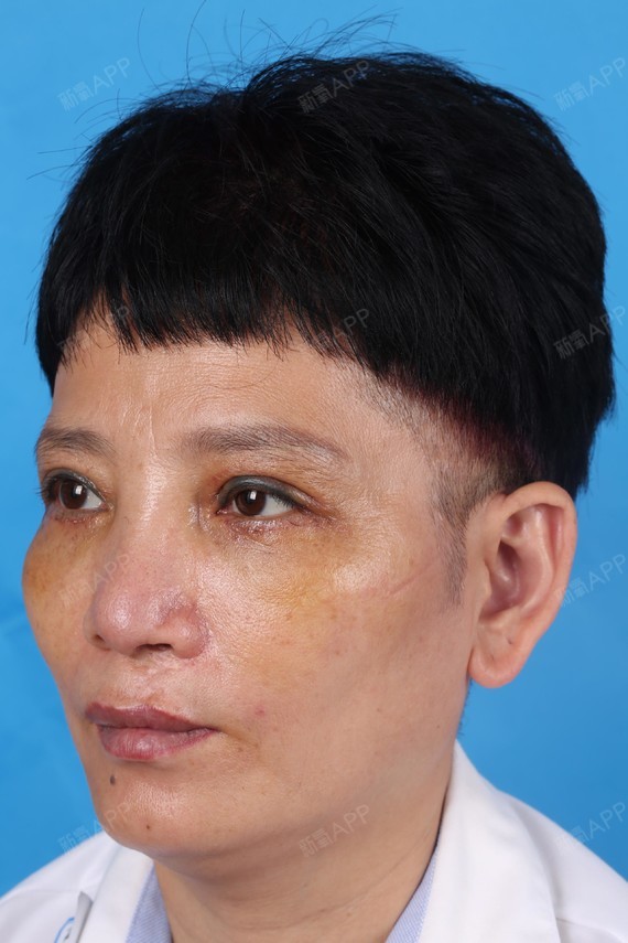 石家庄内切去眼袋好不好_效果图_朱君丽内切去眼袋术后第7天_新氧美容