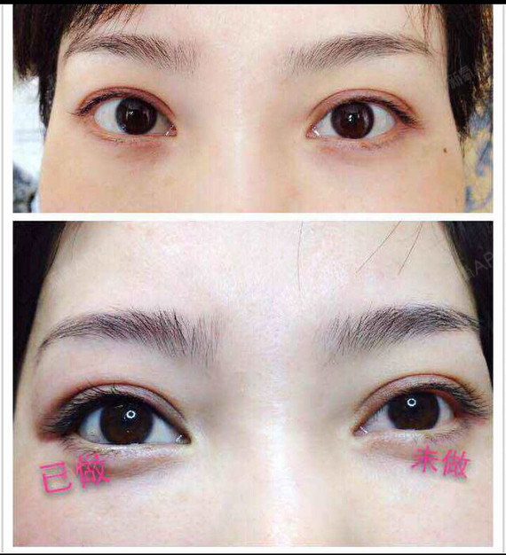 北京半永久美瞳线好不好_效果图_氧气yvnyo半永久美瞳线术后第7天