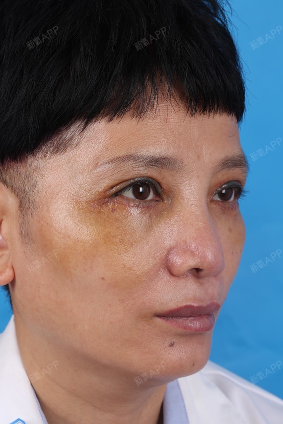 石家庄内切去眼袋好不好_效果图_朱君丽内切去眼袋术后第7天_新氧美容