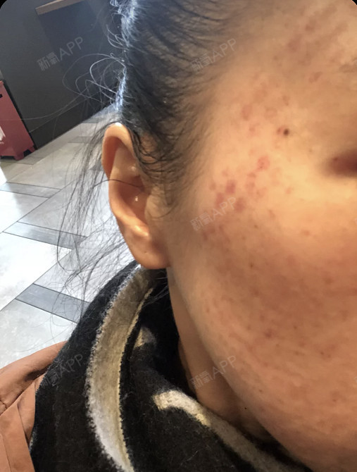 刚弄完水光补水会满脸都是小包,像蚂蚁咬了一样.