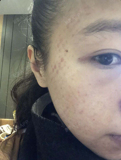 刚弄完水光补水会满脸都是小包,像蚂蚁咬了一样.