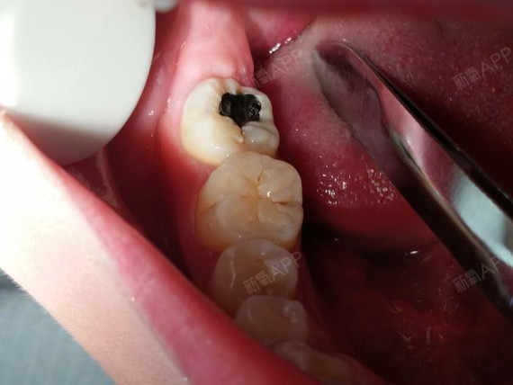 补牙好不好_效果图_dgjhs补牙术后第287天_新氧美容整形