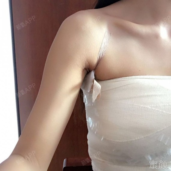 北京自体脂肪隆胸好不好_效果图_氧气2au79fd自体脂肪隆胸术后第8天