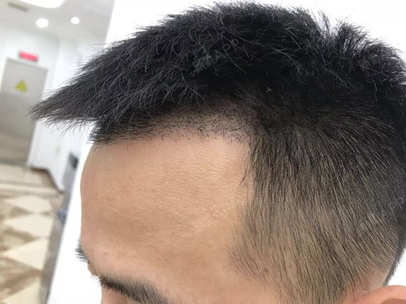 种植区的头发长得还挺快的现在有一厘米多了就是觉得长_圈子-新氧美容