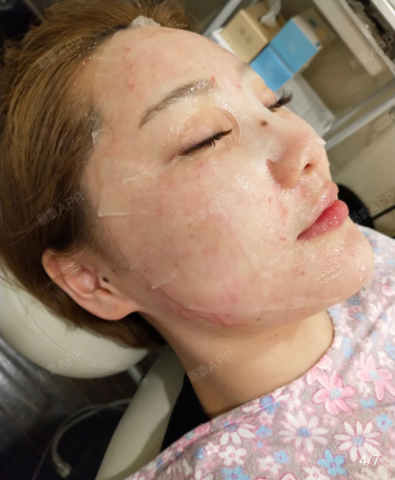 做完水光针有一段时间啦,效果真的没得说,皮肤很饱满_圈子-新氧美容