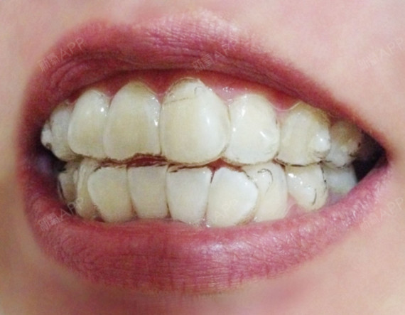 今天复查的又拍了下牙齿的照片看看牙齿移动的情况