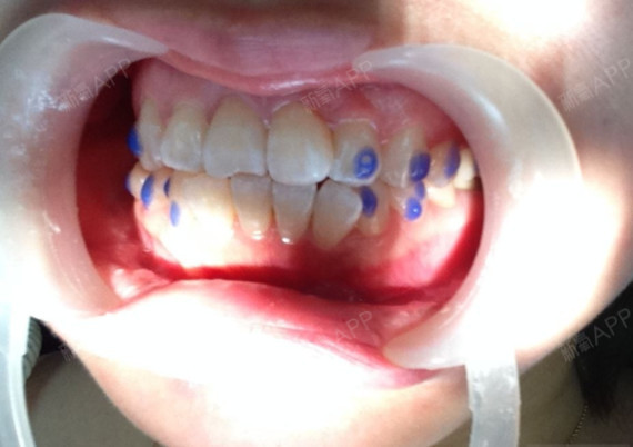 今天复查的又拍了下牙齿的照片看看牙齿移动的情况