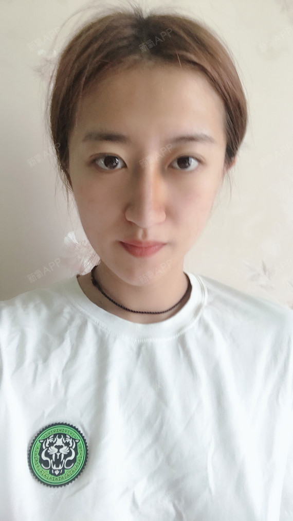 做隆鼻手术已经小10天了,自从拆完线之后,鼻子恢复_圈子-新氧美容整形