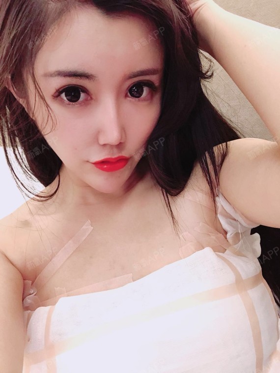 已经术后第7天了,能明显的感觉到我现在的胸部变大