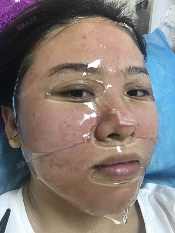 南京美莱伊肤泉微针术后0天