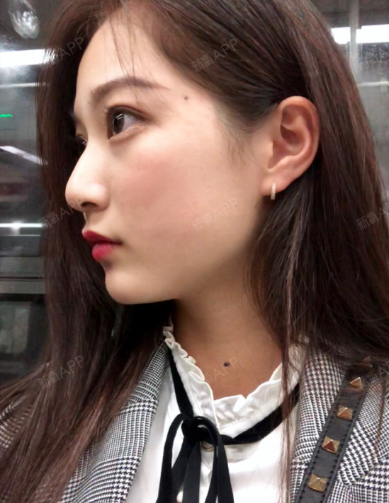 侧脸的角度很完美,流线型曲线没有很突出的咬肌了,气_圈子-新氧美容