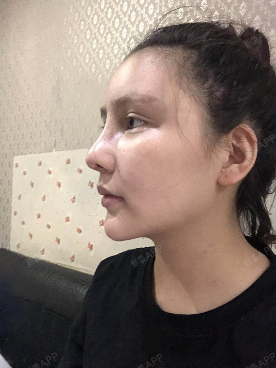 广州鼻部多项好不好_效果图_李雪儿88鼻部多项术后第0天_新氧美容整形