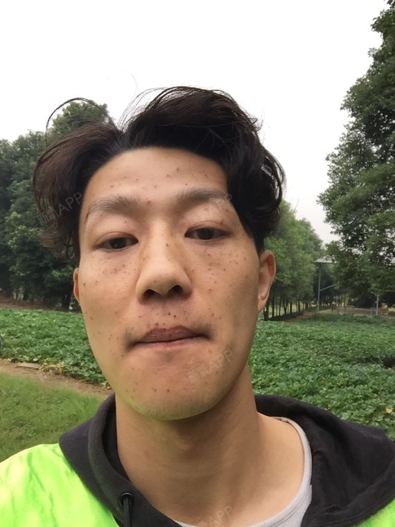 这两天结痂正是严重的时候