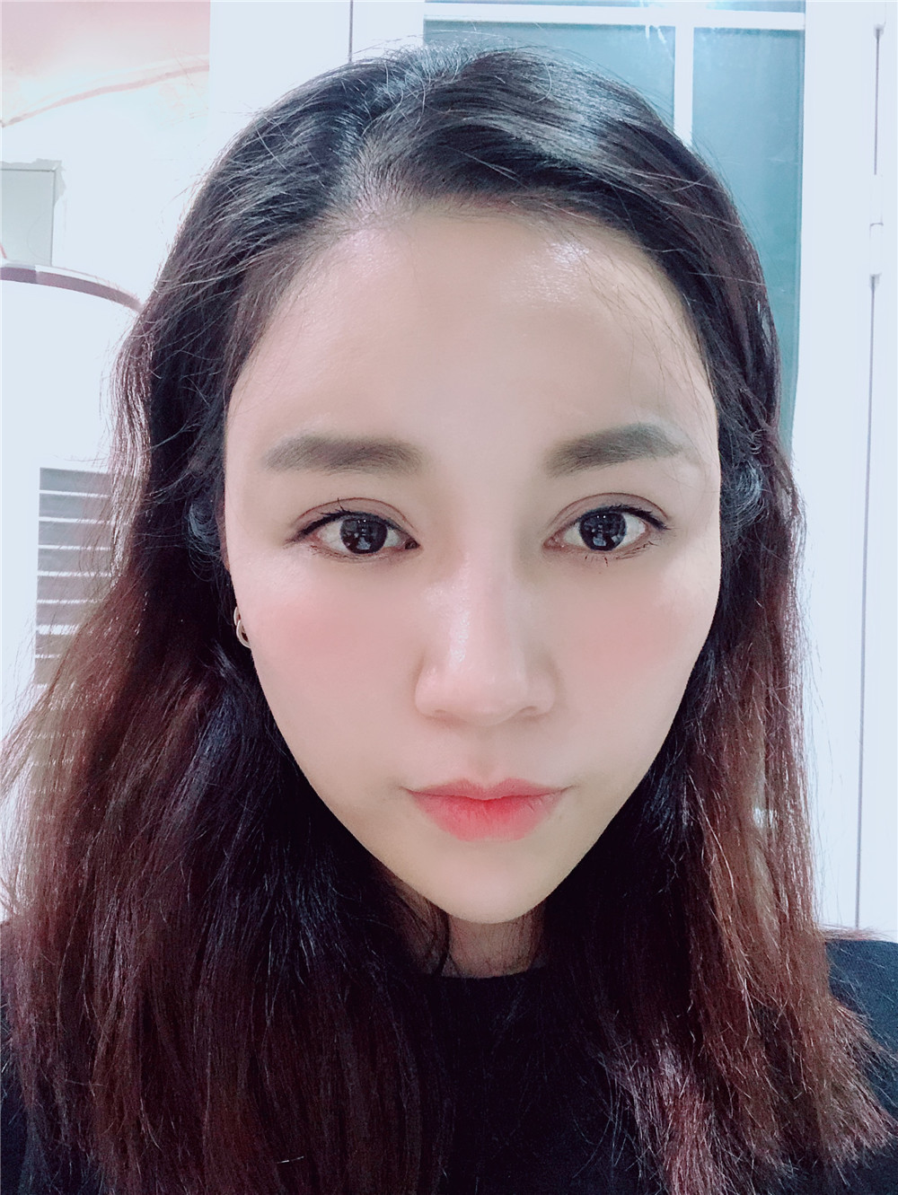 吸脂的效果时间越长看的越明显,而眼睛和脂肪填充恢复的快,效果也很好