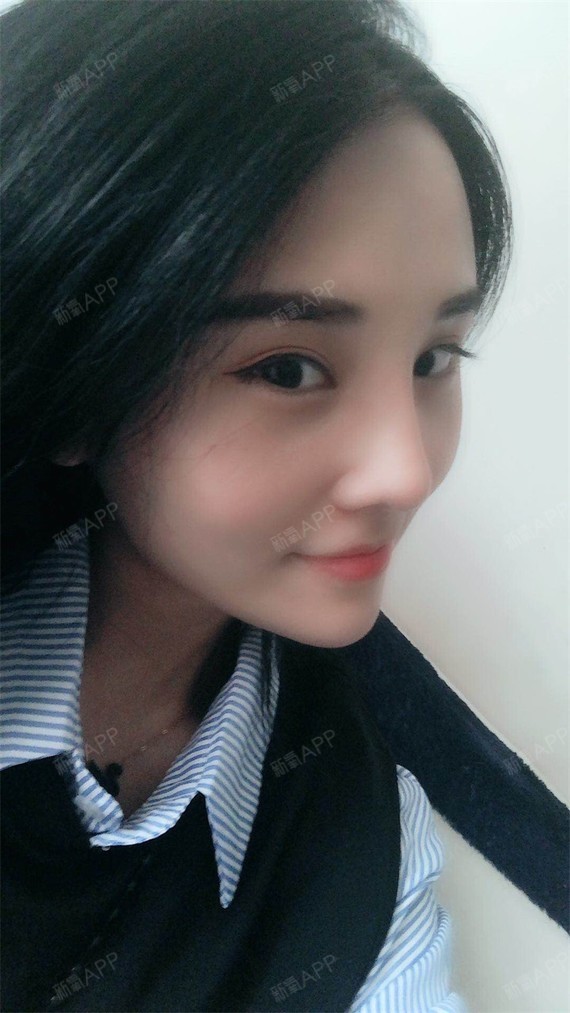 耳软骨复合隆鼻好不好_效果图_红红挤火火耳软骨复合隆鼻术后第31天