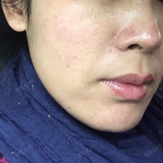 没有美颜处理过哦,手机相机直接拍.感觉痘坑改善了很多!