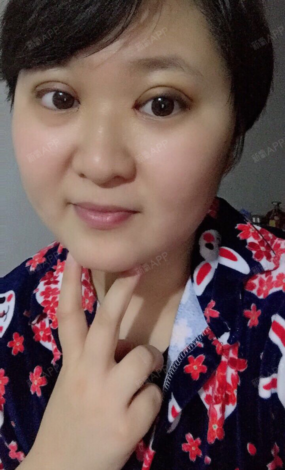埋线双眼皮