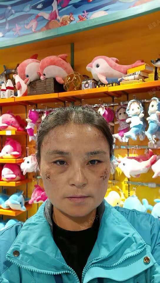 激光祛斑