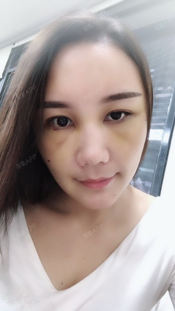 苹果肌.泪沟几个部位_圈子-新氧美容整形