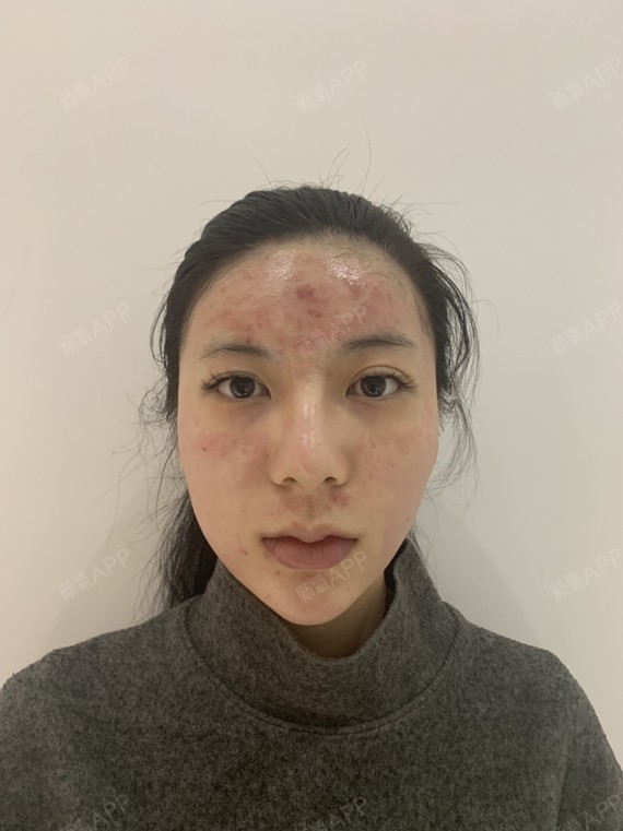 伊肤泉微针好不好_效果图_傲气逼人伊肤泉微针术后第天_新氧美容整形