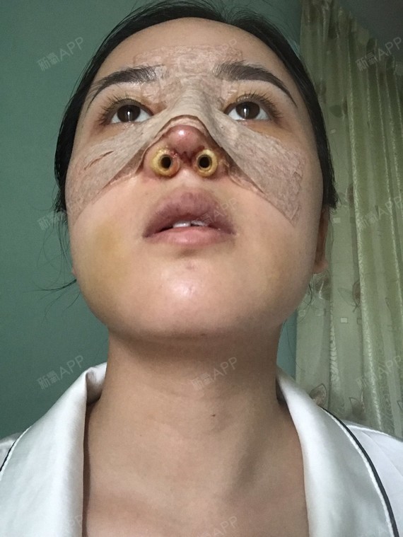 感觉时间过得好慢,才第四天,好想现在已经是半年后了_圈子-新氧美容