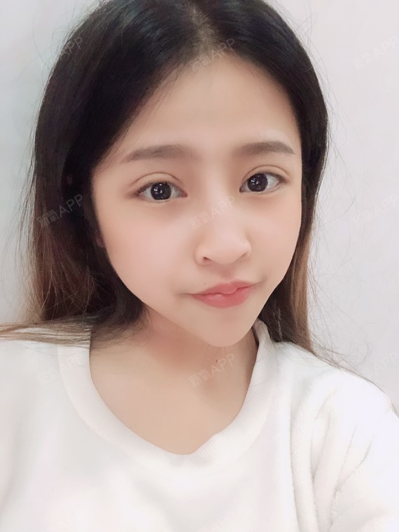 清清美切开双眼皮第15天美丽日记