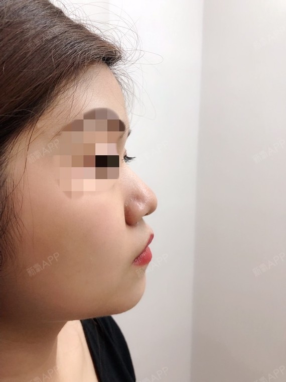 老是被朋友嘲笑塌鼻子,今天陪老妈去做了玻尿酸隆鼻,_圈子-新氧美容