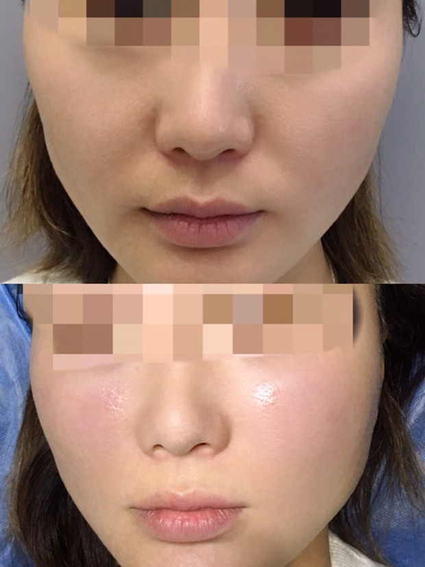 玻尿酸丰苹果肌第0天