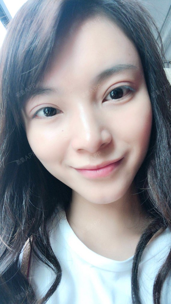 双眼皮术后一个多月了,看图说话,眼睛恢复挺好的,形_圈子-新氧美容