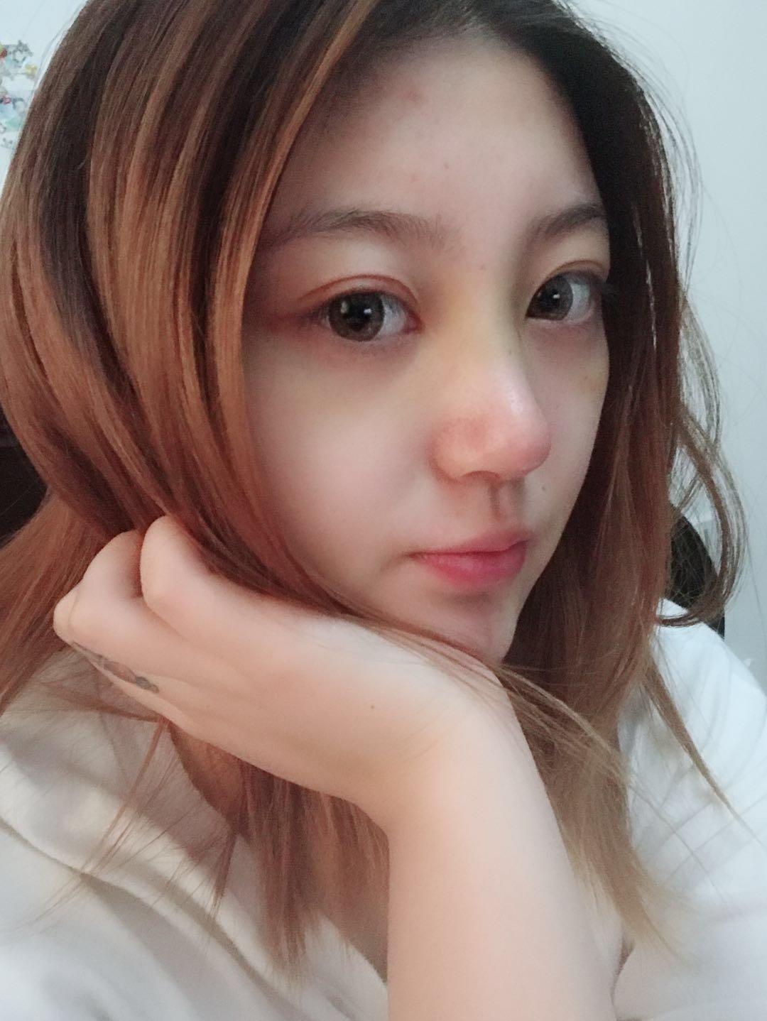 膨体隆鼻怎么样_恢复过程_效果如何_巧克力豆太腻整形日记9.