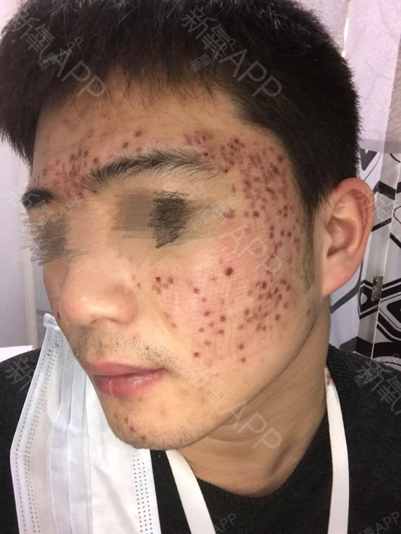 亲身经历分享:在长沙做了2次点阵激光,个人觉得比较有效果,所以写日记