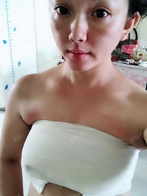 露丝唐假体隆胸第3天美丽日记