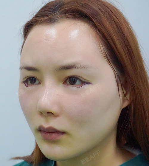 上海开外眼角好不好_效果图_薛芳宝宝开外眼角术后第0天_新氧美容整形