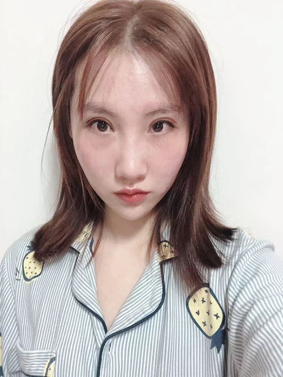 不过我马上就可以拥有完美的双眼皮了,哈哈