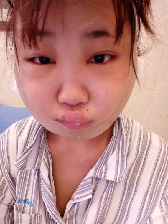 还记得刚做完手术后的第一天一个字形容肿丑痛呜呜呜真的好肿啊我都不