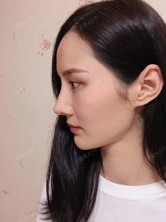 在海峡做了海峡黄金三角鼻雕后,无论怎么什么角度,都_圈子-新氧美容