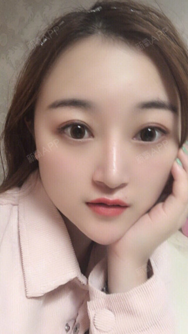 广州肋软骨隆鼻好不好_效果图_氧气x0y8g肋软骨隆鼻术后第123天_新氧