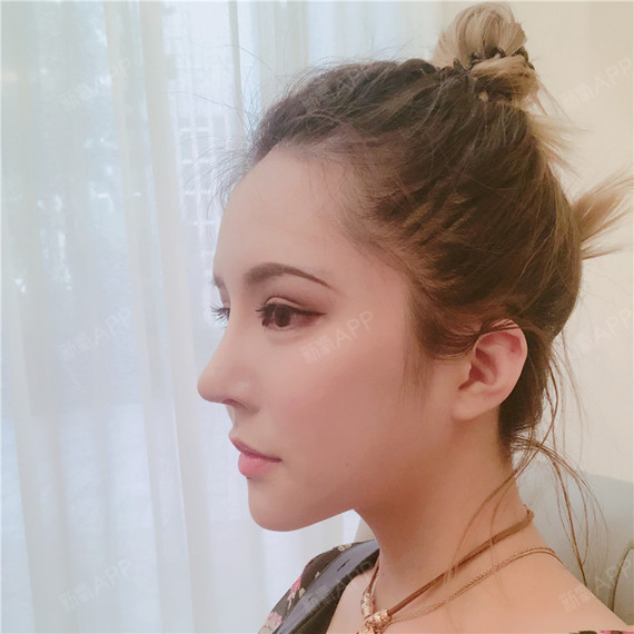 肋软骨隆鼻好不好_效果图_大城漫小爱肋软骨隆鼻术后第30天_新氧美容