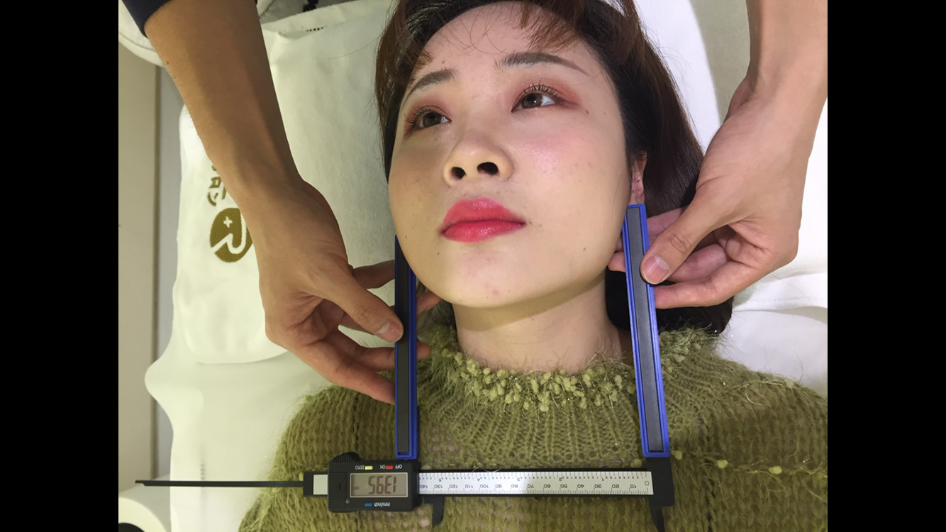 日本ritz精奢美容小颜整骨正骨术怎么样_恢复过程_效果如何_氧气y523f
