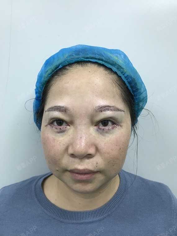 武汉外切去眼袋好不好_效果图_智慧大师外切去眼袋术后第1天_新氧美容