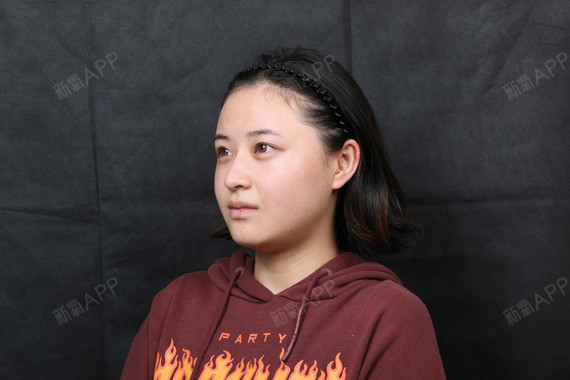 常州注射瘦脸好不好_效果图_cjjjj注射瘦脸术后第31天_新氧美容整形