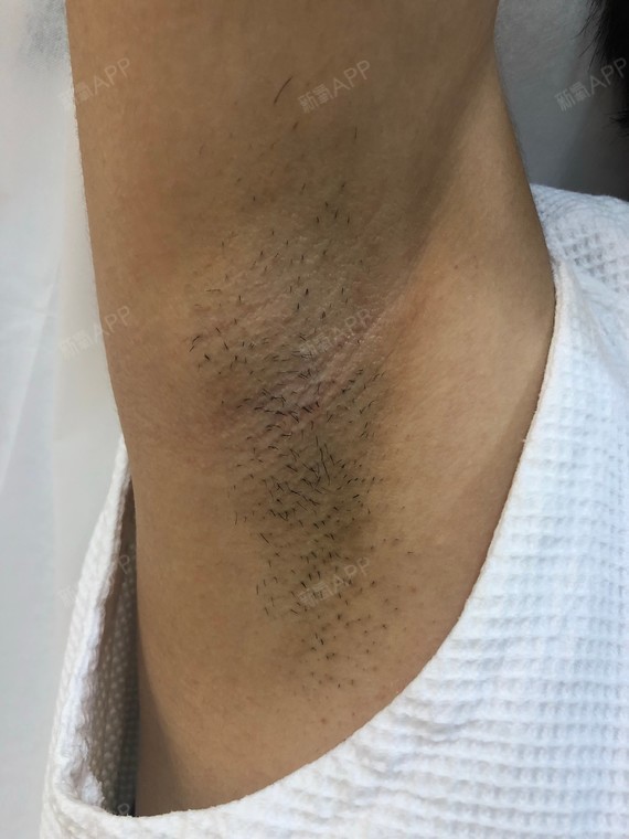 我的腋下毛特别多,尤其夏天的时候最尴尬,经常都要用_圈子-新氧美容