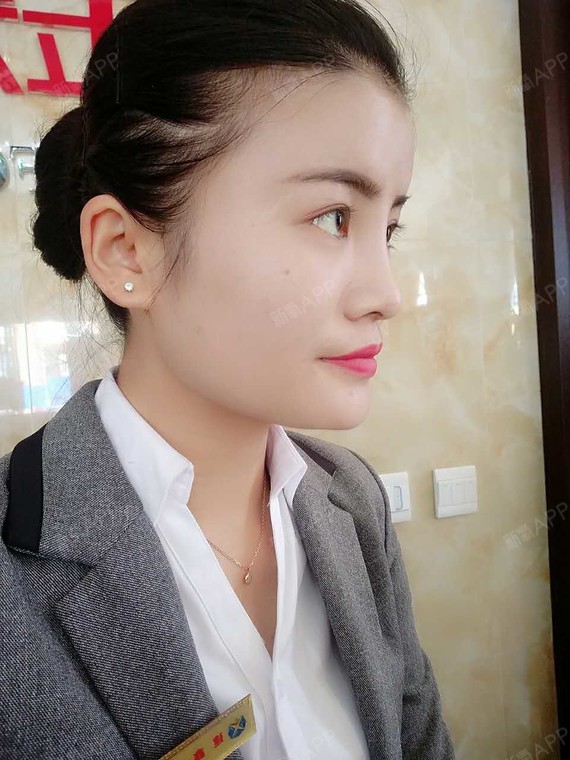 鼻子的侧面现在拍照特别的好看,感觉脂肪好像吸收一些_圈子-新氧美容