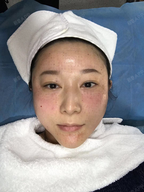 医生让我躺在诊疗床上,细心帮我将麻药清理下去,然后开始为我注射水光