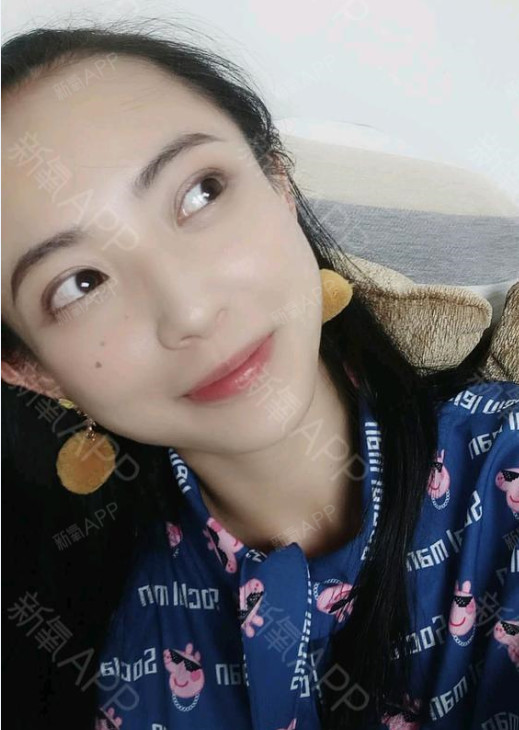 目前来看,双眼皮的样子真的是越来越顺眼,有时候翻到以前单眼皮的照片