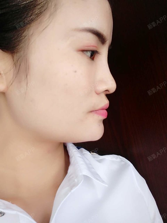 南京膨体隆鼻好不好_效果图_外有美人皮内有玲珑心膨体隆鼻术后第60天